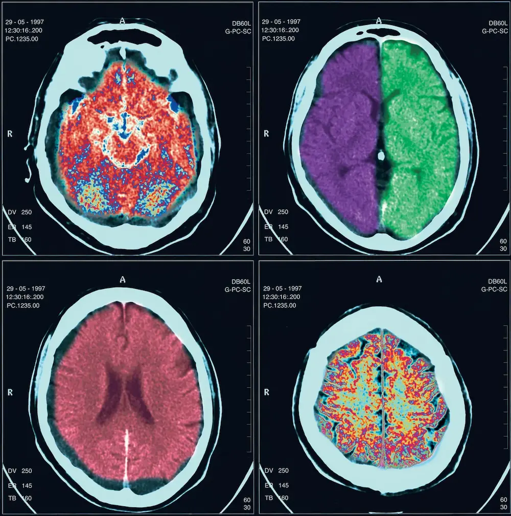 brain scan types