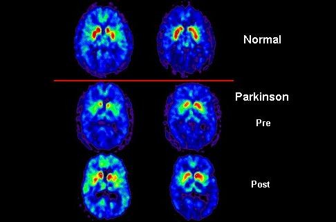 
Positron-Emission-Tomography-PET-Scan