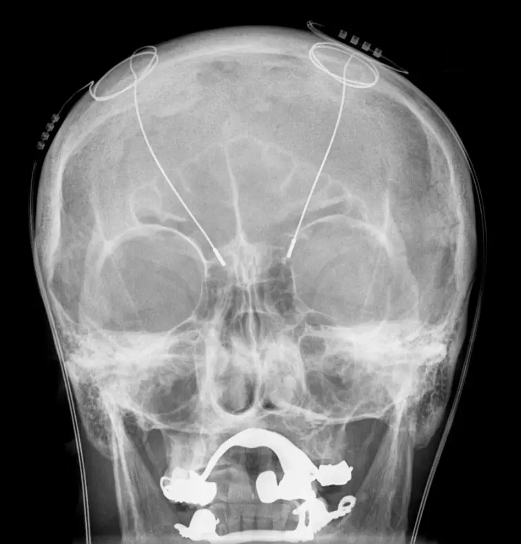 deep brain stimulation parkinson's