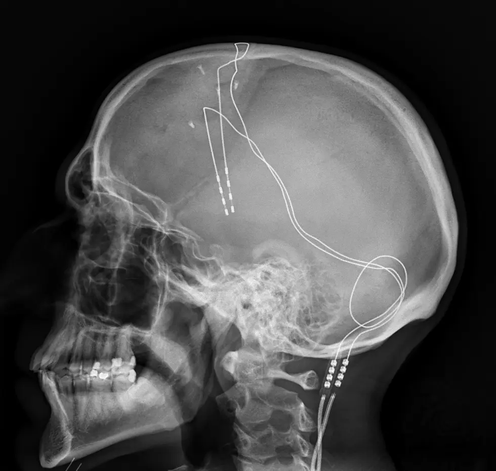 deep brain stimulation parkinson's