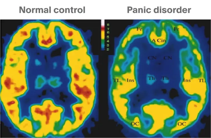 brain scan