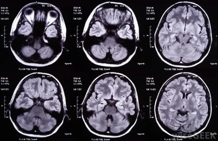 brain scan types